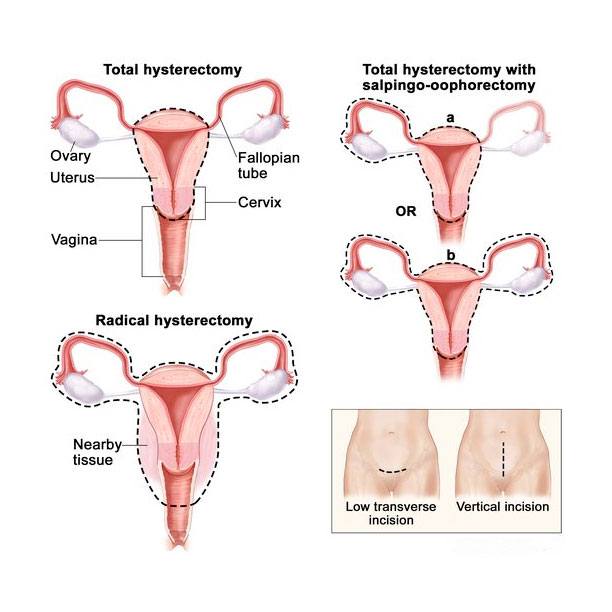 Different kinds of hysterectomy